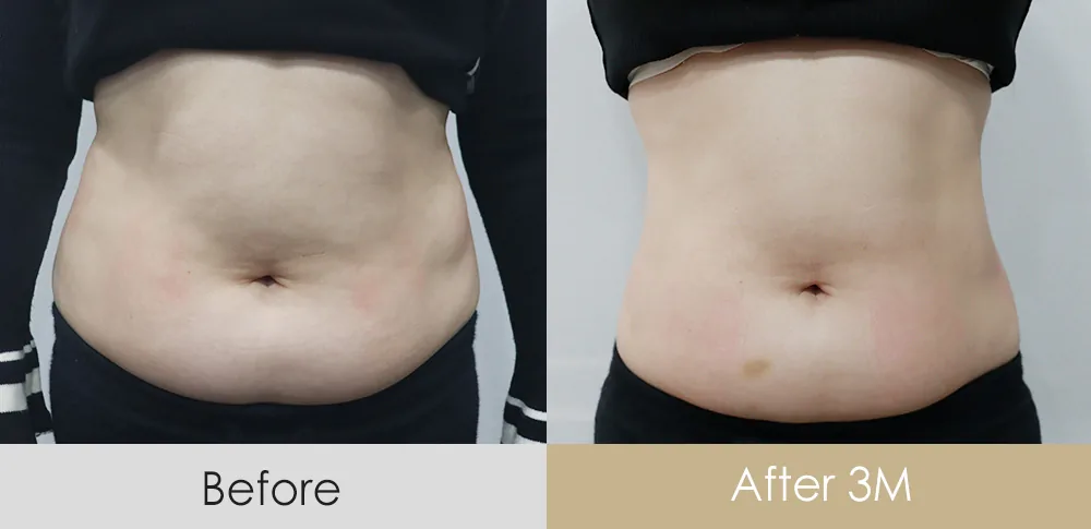 Lipolysis injection — abdomen · 3 months after