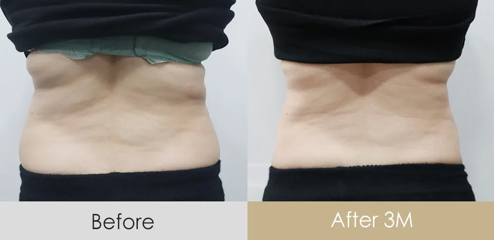 Lipolysis injection — flanks · 3 months after