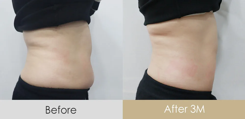 Lipolysis injection — abdomen (side view) · 3 months after