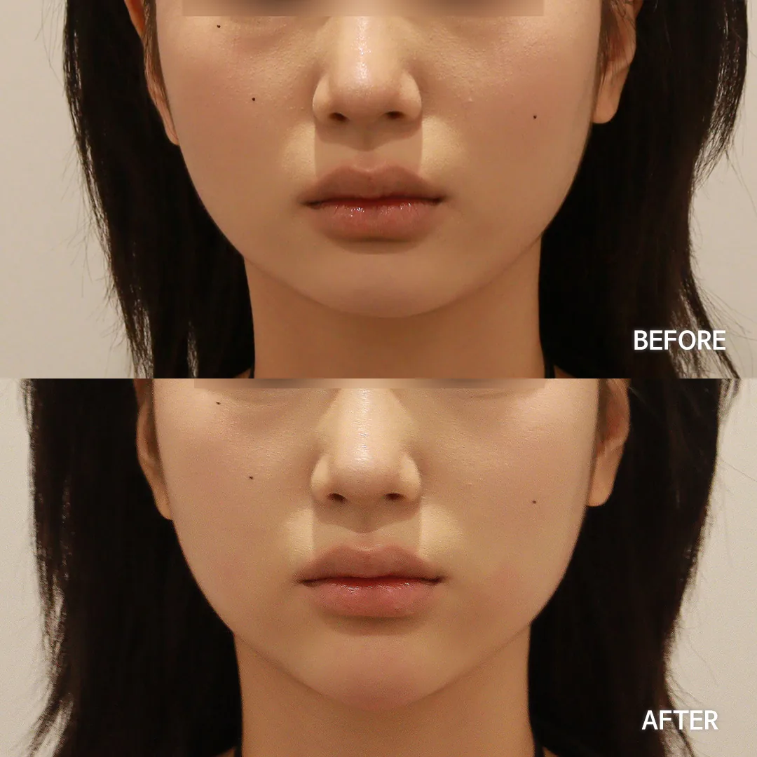Chin filler — before and after, front view