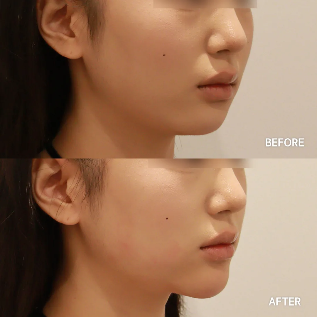 Chin filler — before and after, side profile