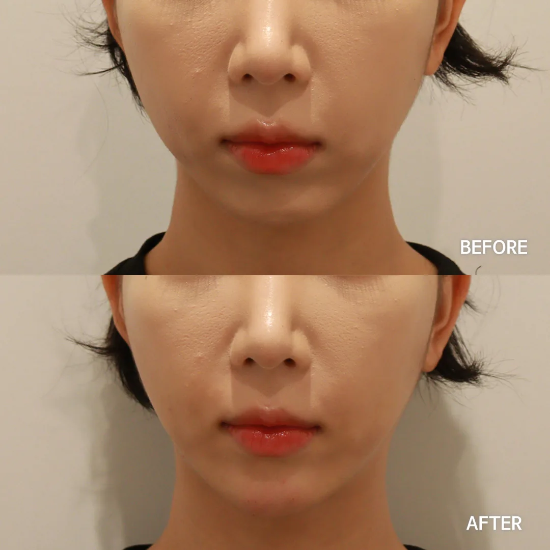 Chin filler — before and after, front view