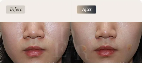 D-ARC Solution — Juvelook stage, cheek texture · before / after