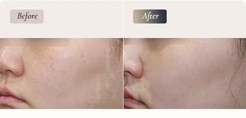 D-ARC Solution — pico laser stage, pigment marks · before / after