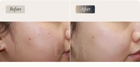 D-ARC Solution — pico laser stage · before / after