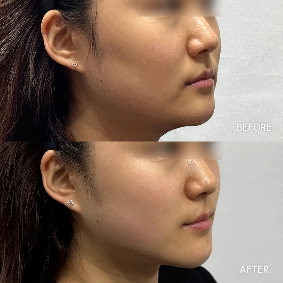 Onda lifting — jawline and lower face (3/4) · before / after — Dear Clinic