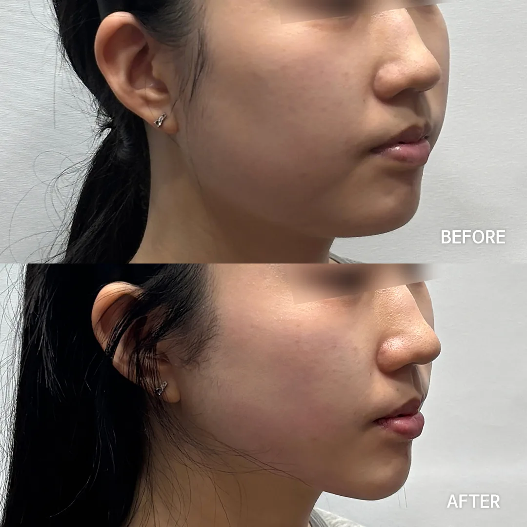 Onda lifting — jawline and lower face (3/4) · before / after — Dear Clinic