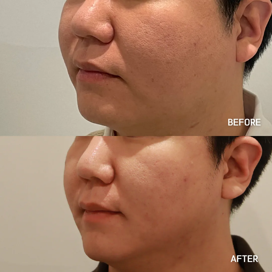 Salivary gland botox — lower face and jaw slimming (3/4 view) · before / after