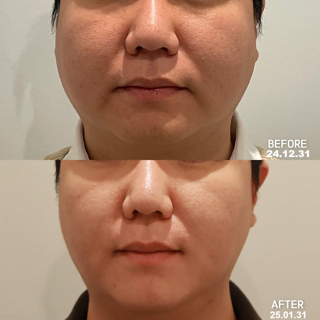 Salivary gland botox — lower face slimming · 1 month after (2024.12.31 → 2025.01.31)