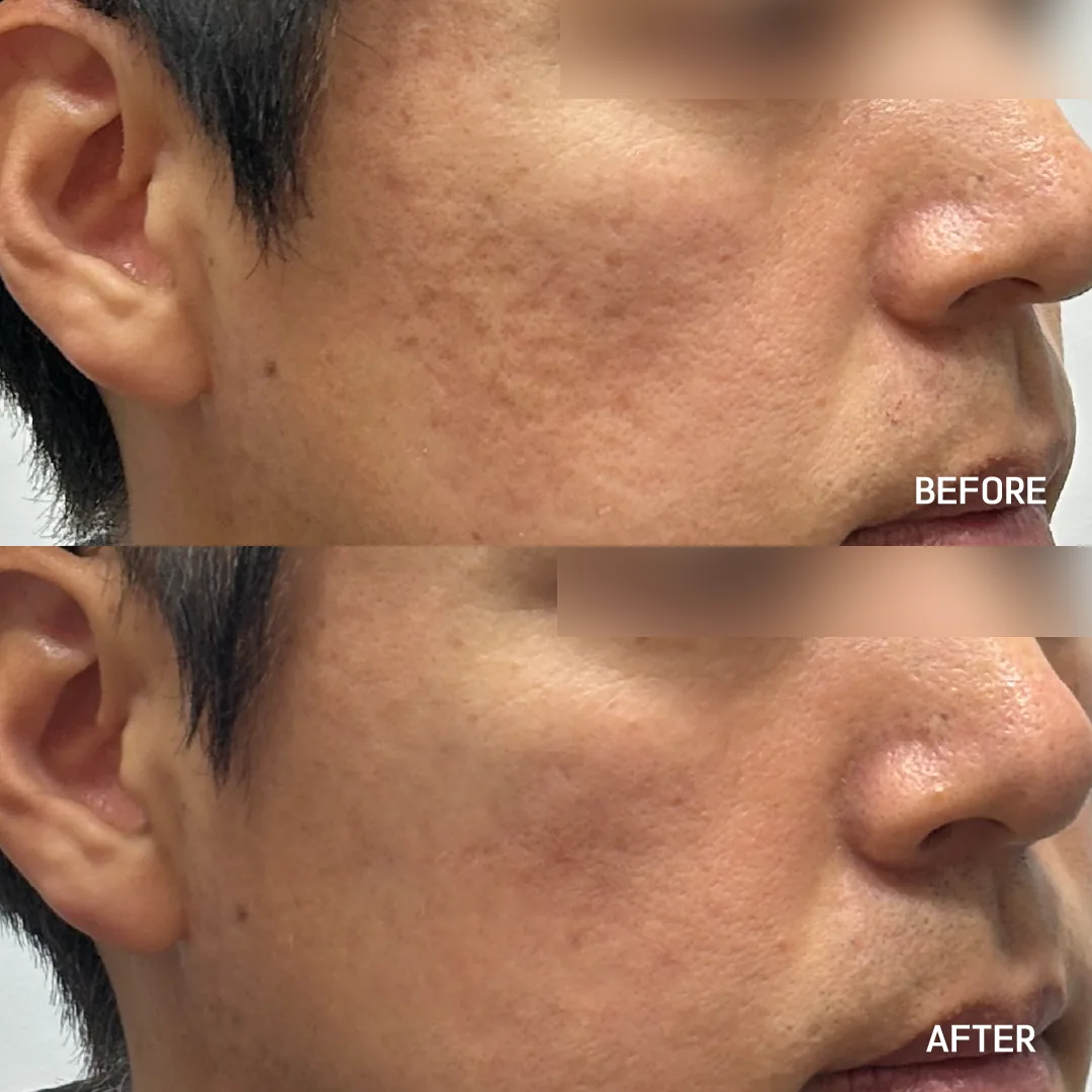 Acne scar laser — cheek scarring and texture · before / after