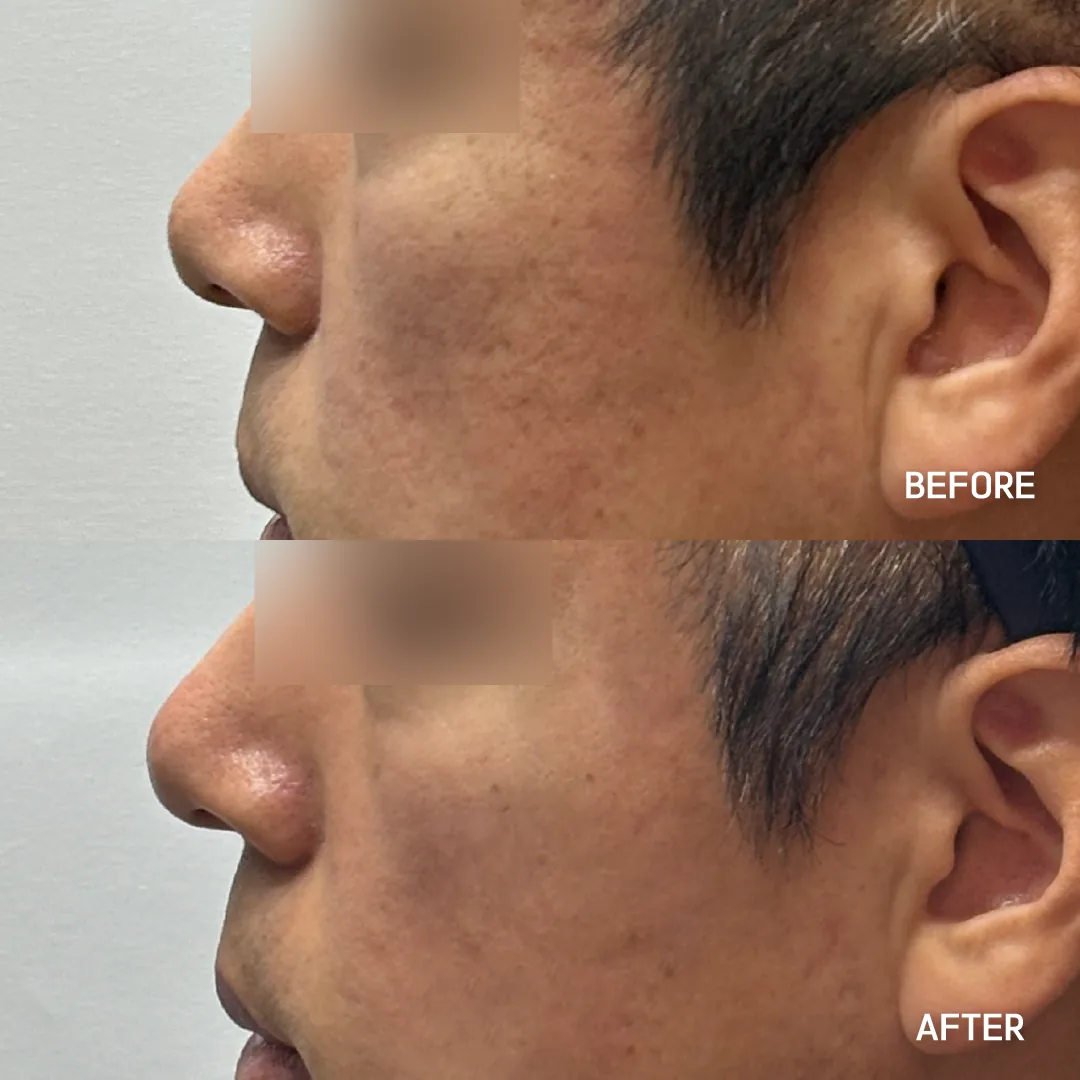 Acne scar laser — cheek and temple scarring (profile) · before / after