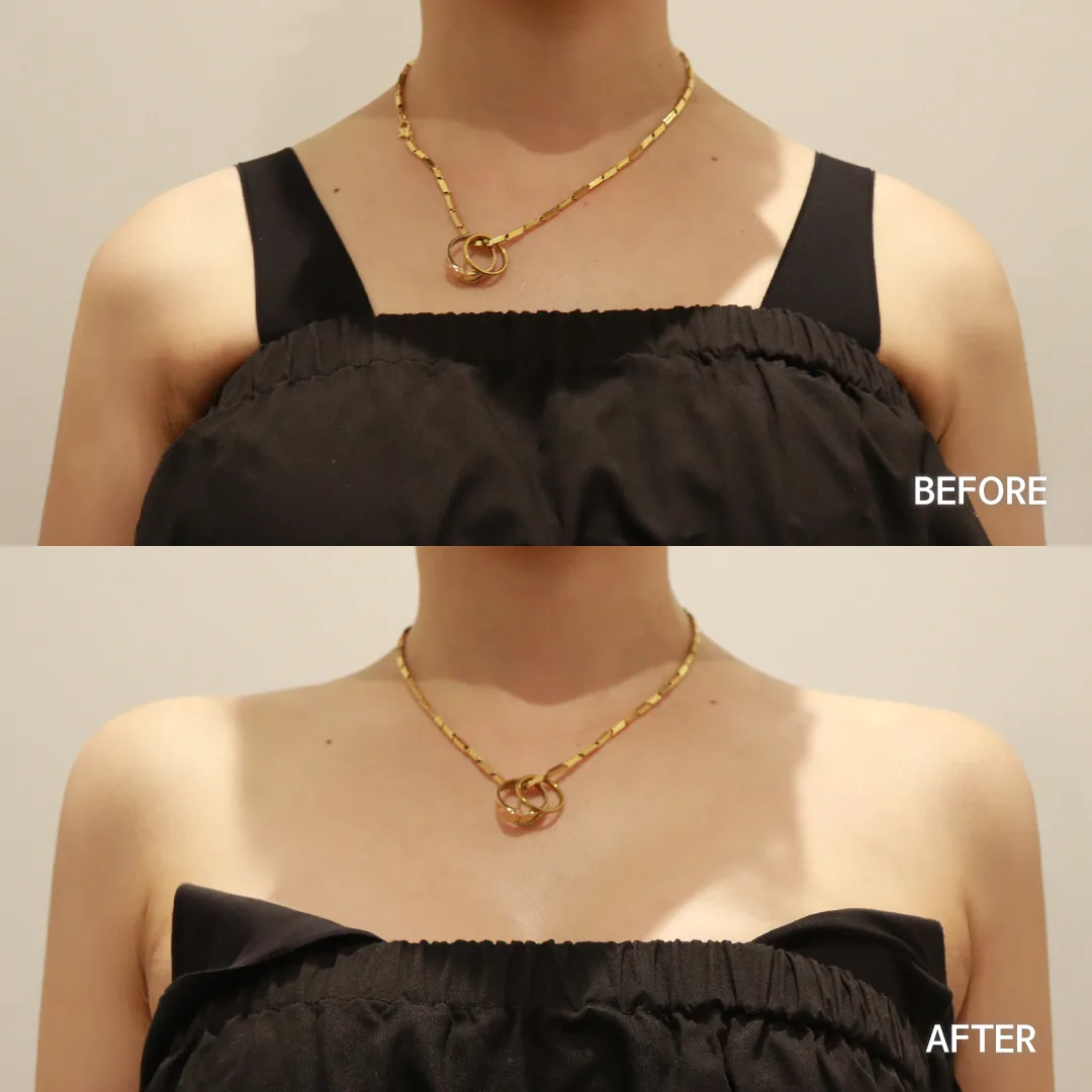 Shoulder filler — before and after