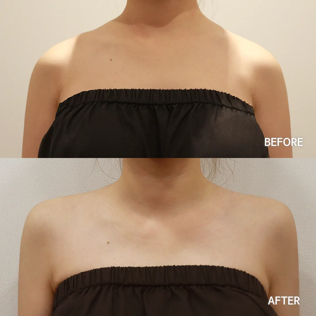 Shoulder filler — before and after