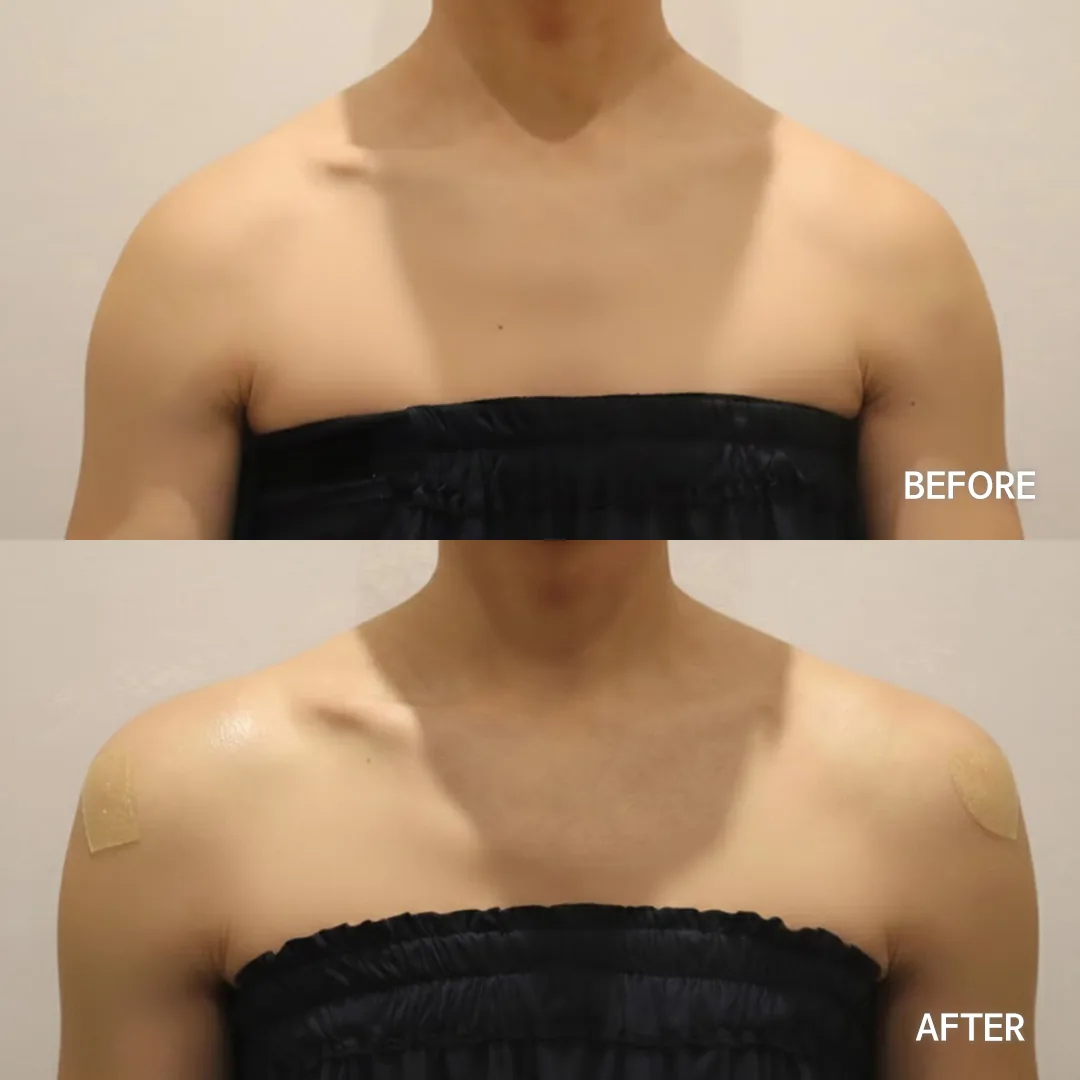 Shoulder filler — before and after