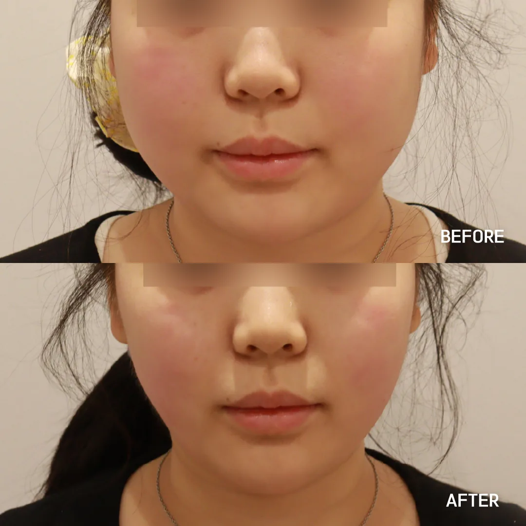 Shurink Universe HIFU lifting before and after — same patient, tighter jawline, Dear Clinic case