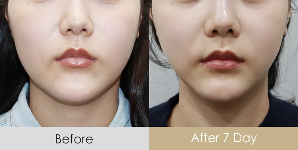 Thread lift — jawline and lower face · 7 days after