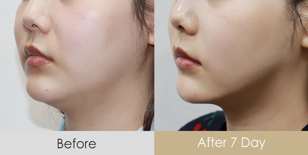 Thread lift — jawline and under-chin contour (3/4 view) · 7 days after — Dear Clinic