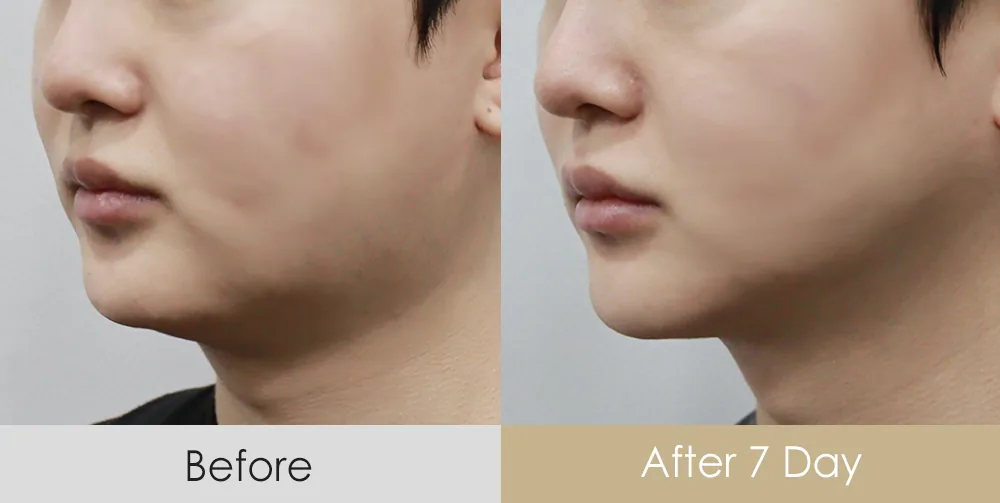 Thread lift — jaw and under-chin contour (male patient, 3/4 view) · 7 days after — Dear Clinic