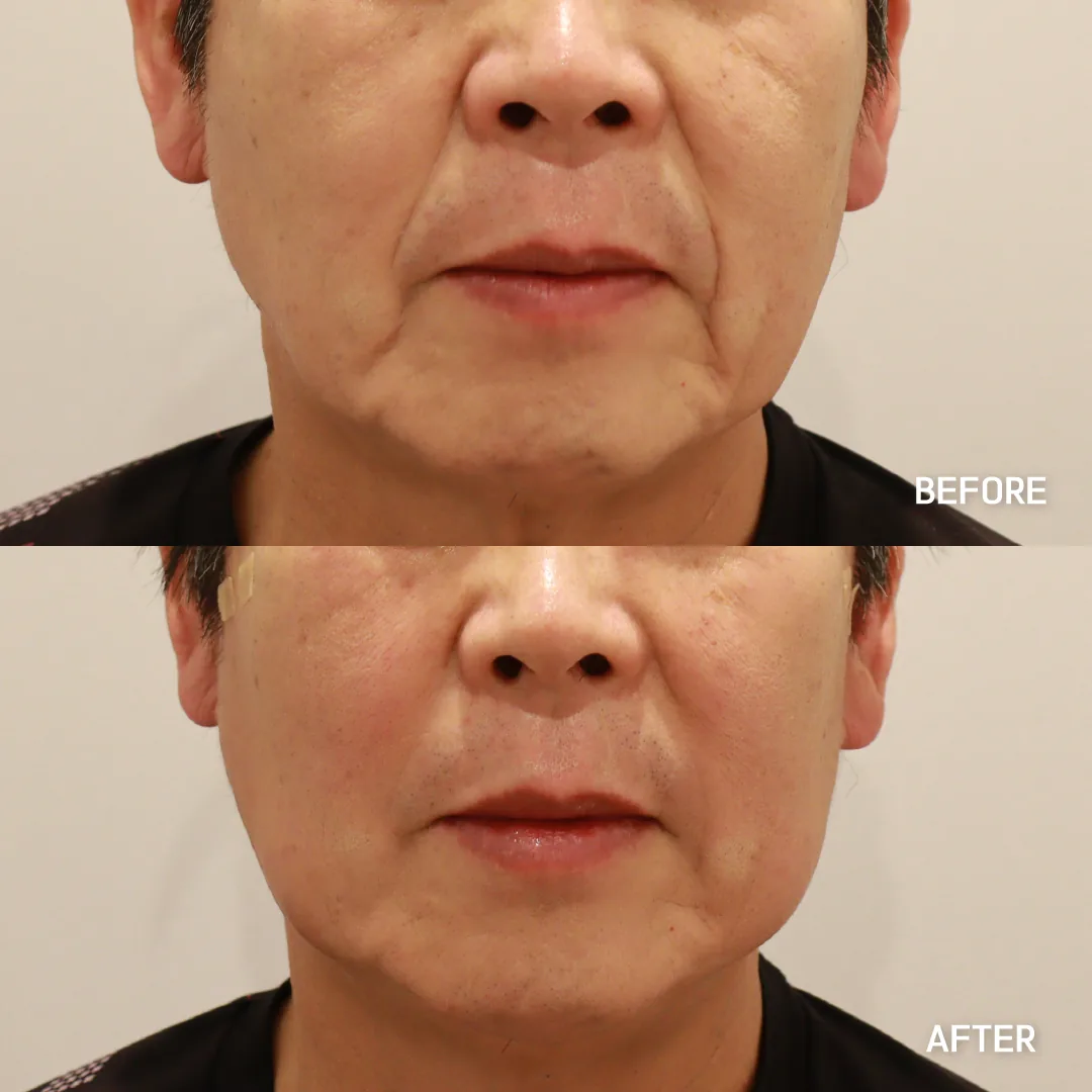 Thread lift — nasolabial folds and jowl line · before / after — Dear Clinic