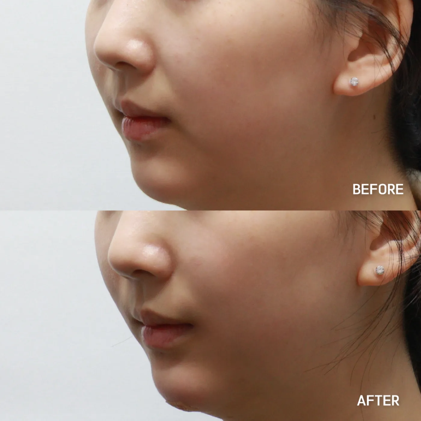 Anterior cheek filler before and after — Dear Clinic