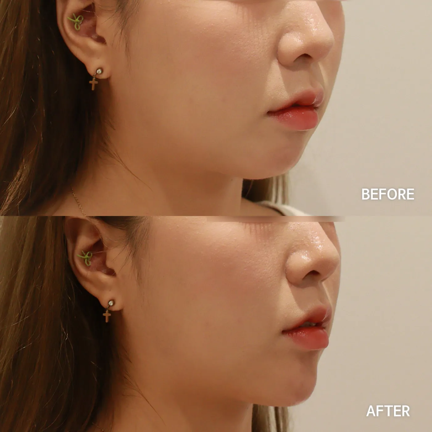 Chin filler before and after — Dear Clinic case