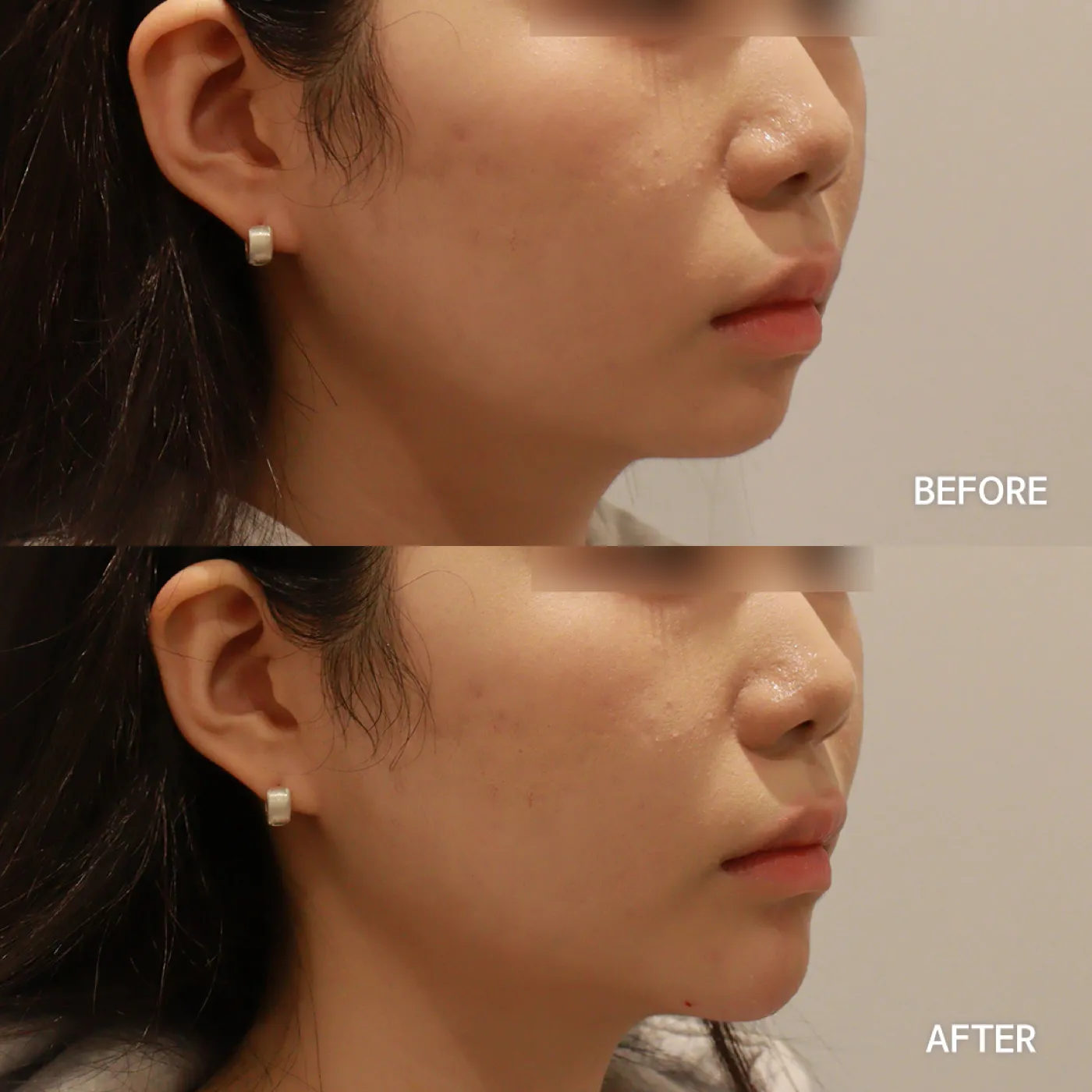 Chin filler before and after side profile — Dear Clinic