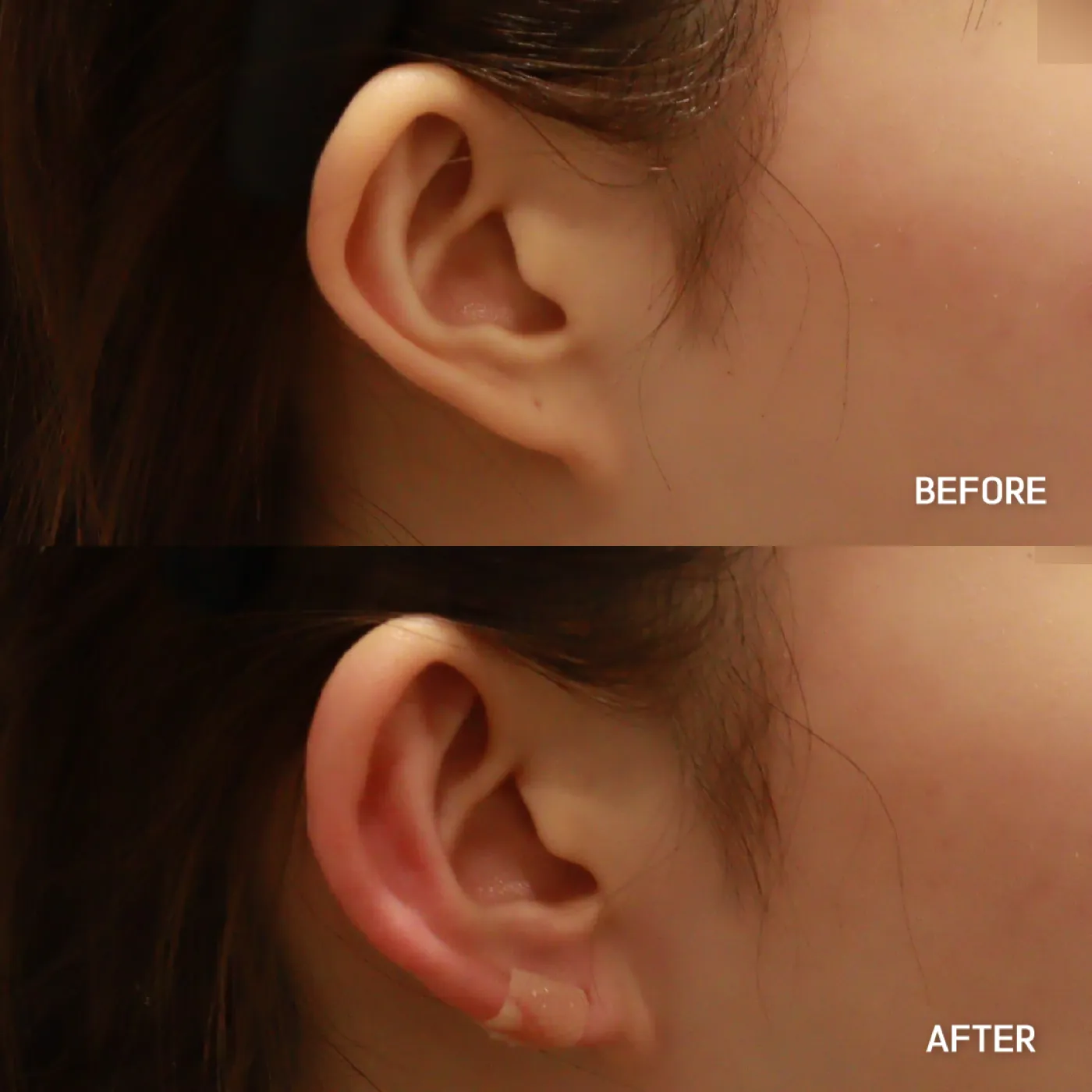 Earlobe filler before and after — Dear Clinic case