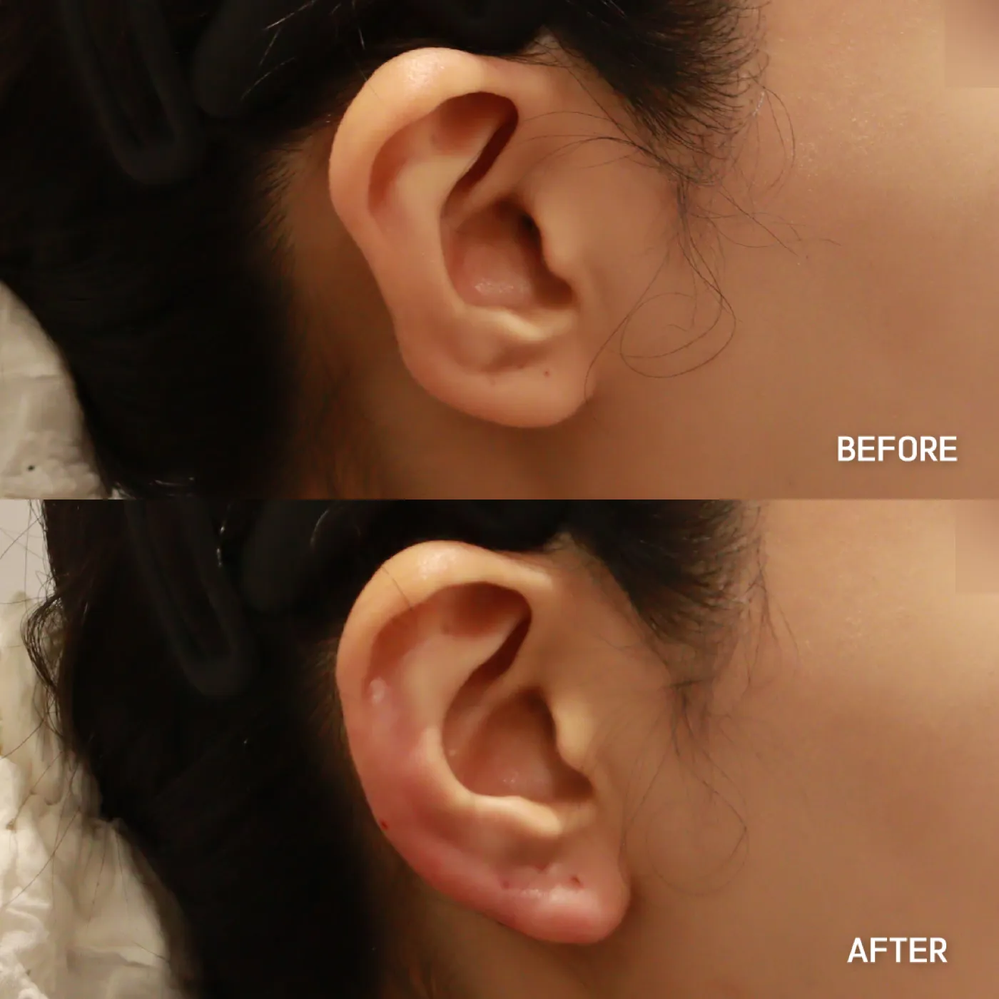 Earlobe filler before and after — Dear Clinic