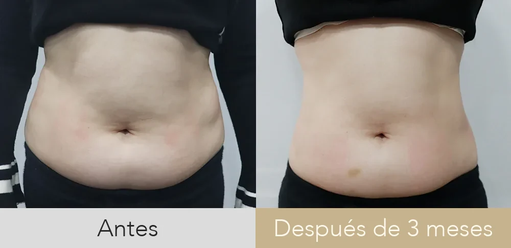 Inyección lipolítica — abdomen · 3 meses después