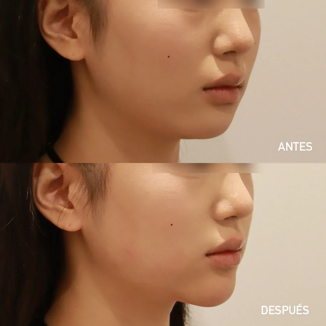 Relleno de mentón — antes y después, perfil lateral