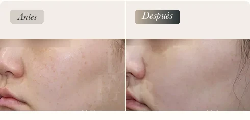 D-ARC Solution — etapa de láser pico, manchas · antes / después
