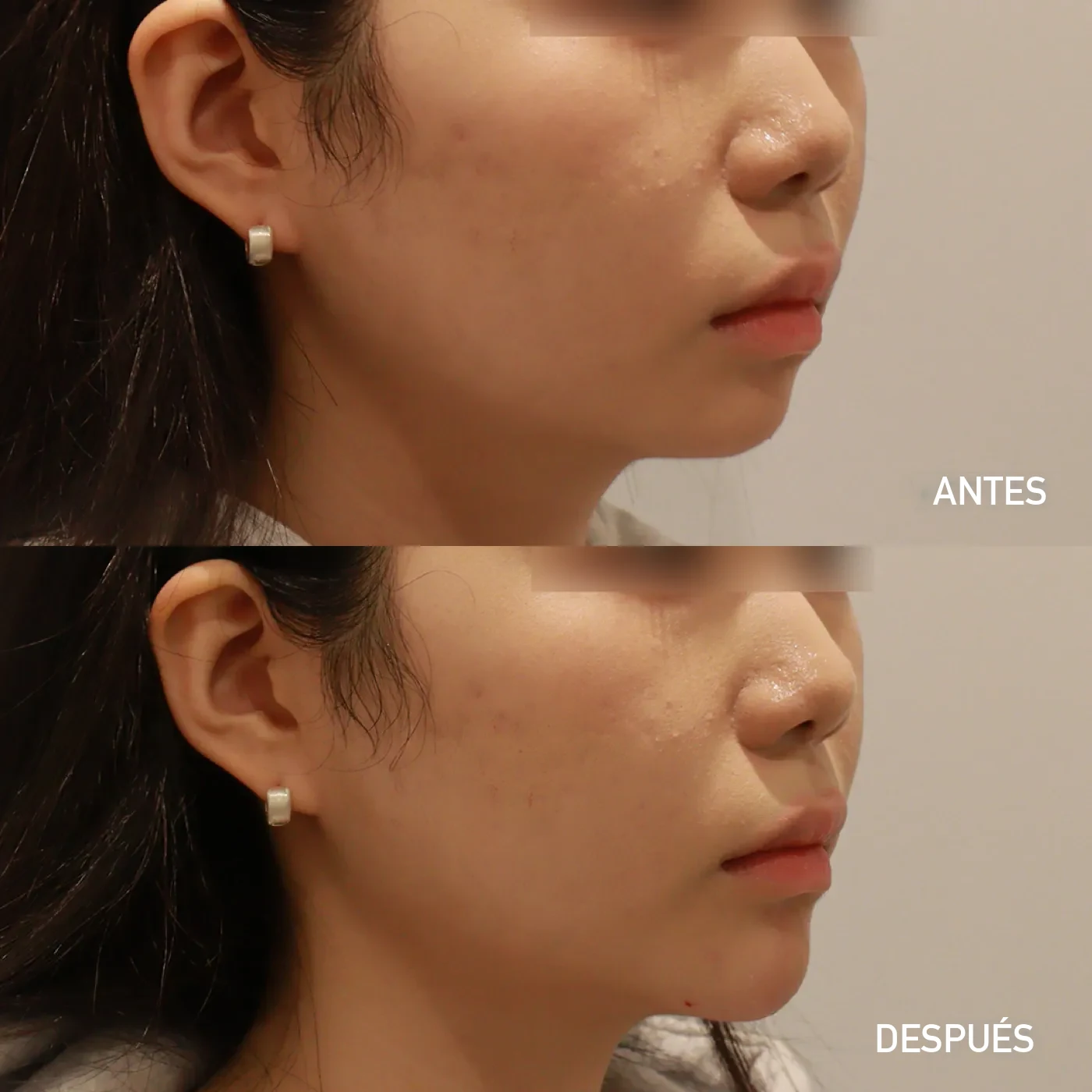 Relleno de mentón (chin) antes y después de perfil — Dear clínica