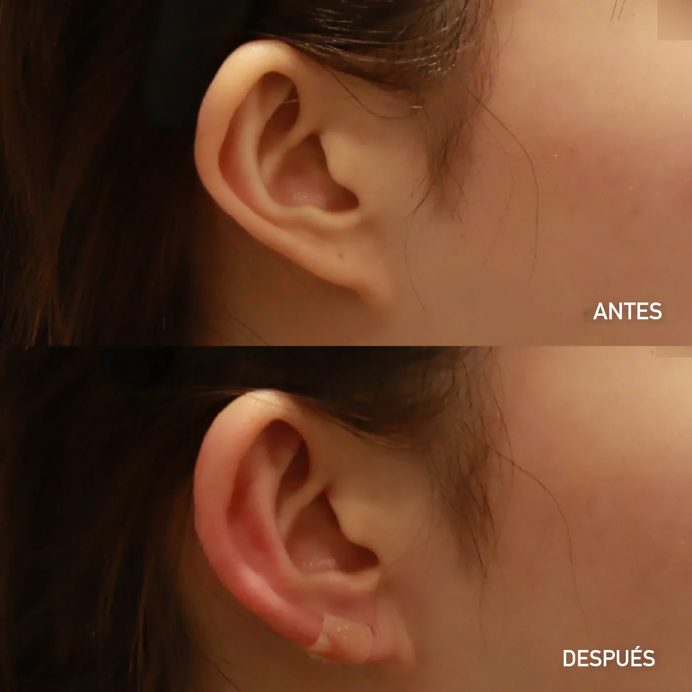 Relleno de lóbulo de oreja (earlobe) antes y después — caso de Dear clínica