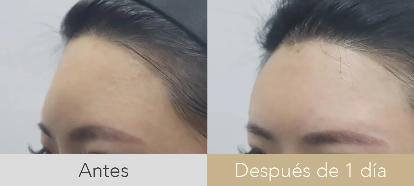 Caso de relleno de frente en Dear clínica: un plano aplanado devuelto a una curva más suave, visto de perfil, antes y después