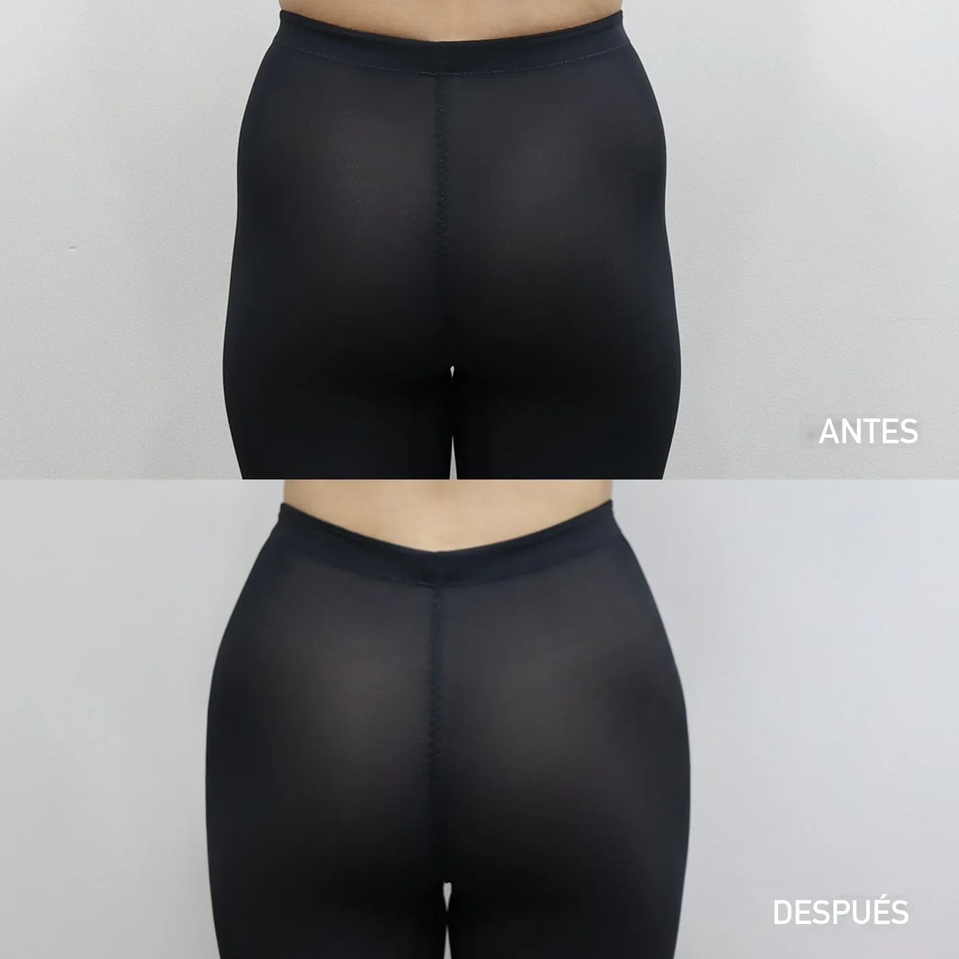 Relleno de cadera antes y después — línea de cadera más llena en Dear clínica