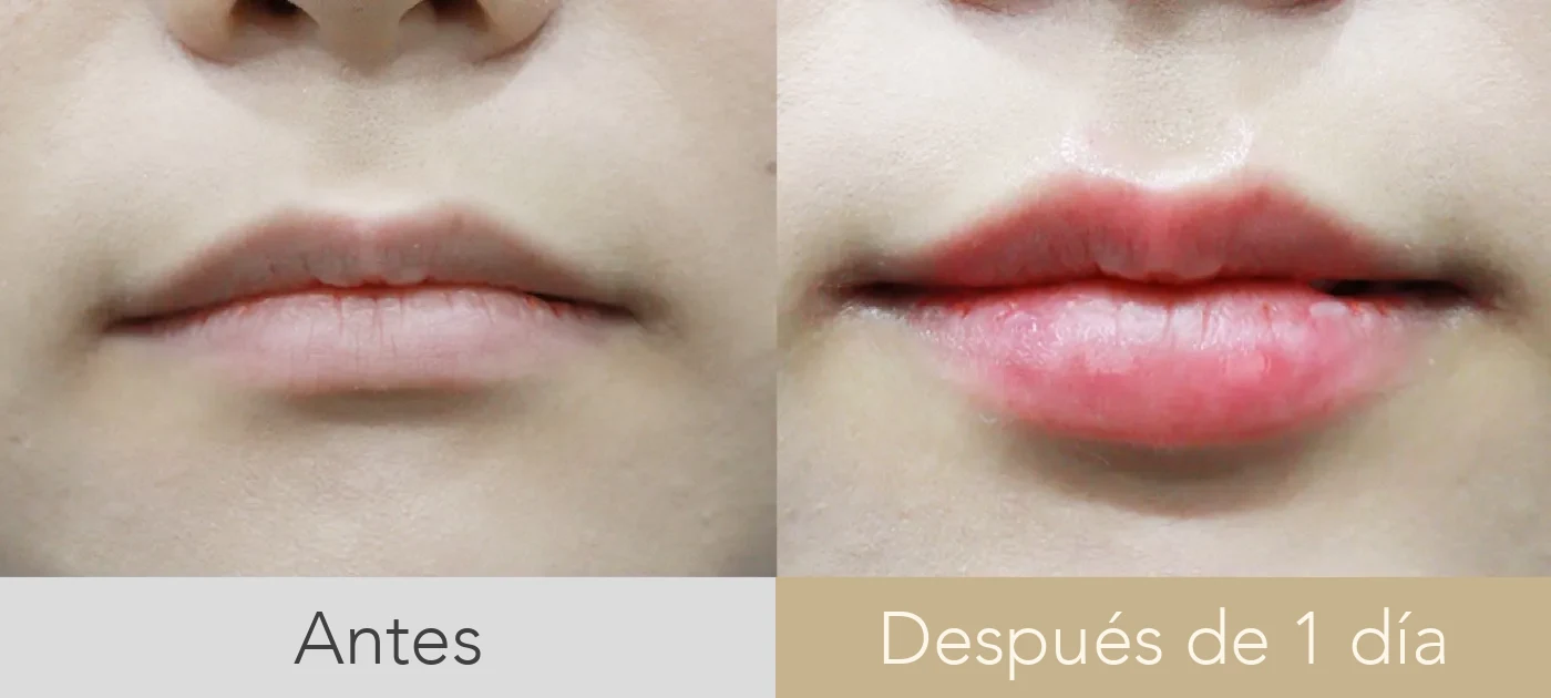 Antes y después de relleno de labios en Dear clínica, con el contorno definido y la proporción entre labio superior e inferior equilibrada