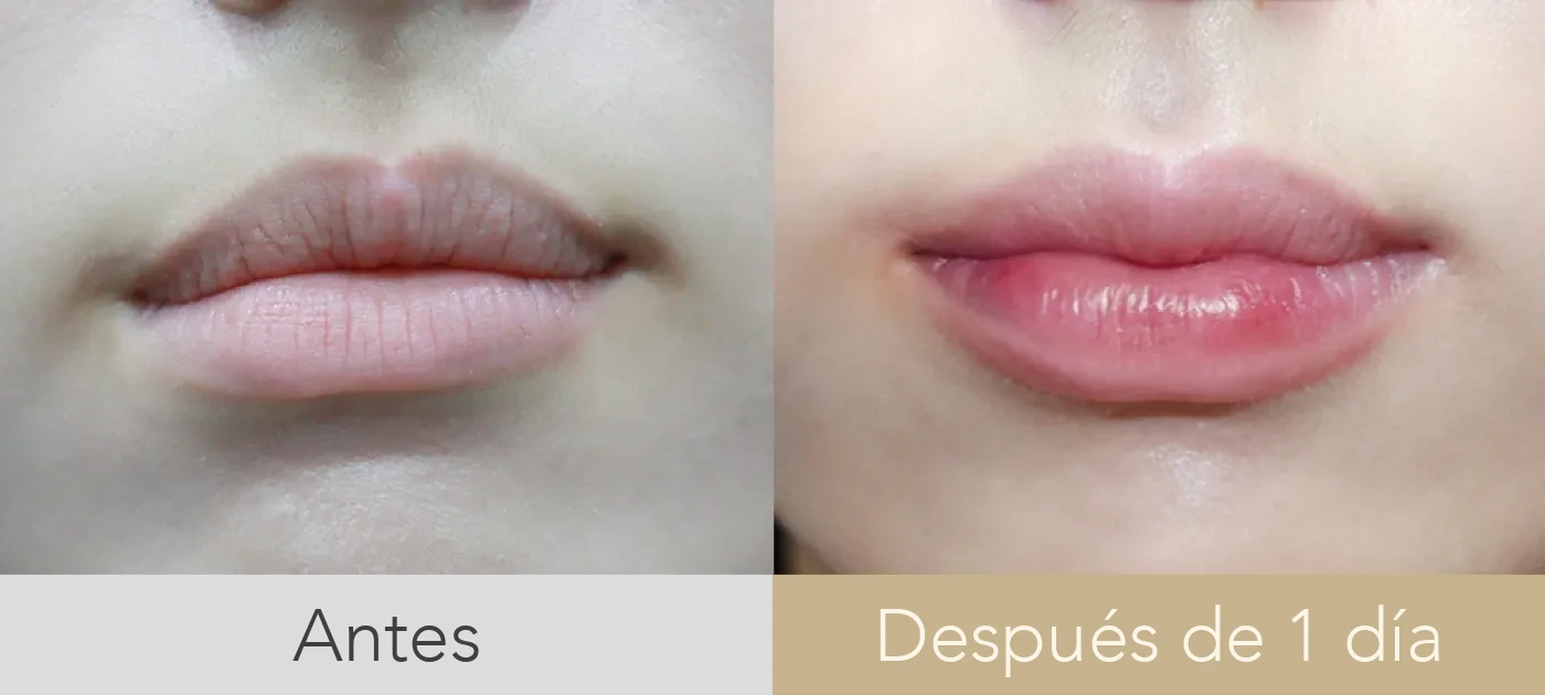 Antes y después de relleno de labios en Dear clínica, con las comisuras sostenidas y el volumen repartido en dos capas