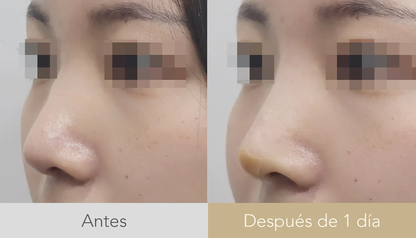 Antes y después de relleno de nariz en Dear clínica, con la línea del dorso refinada sin cirugía