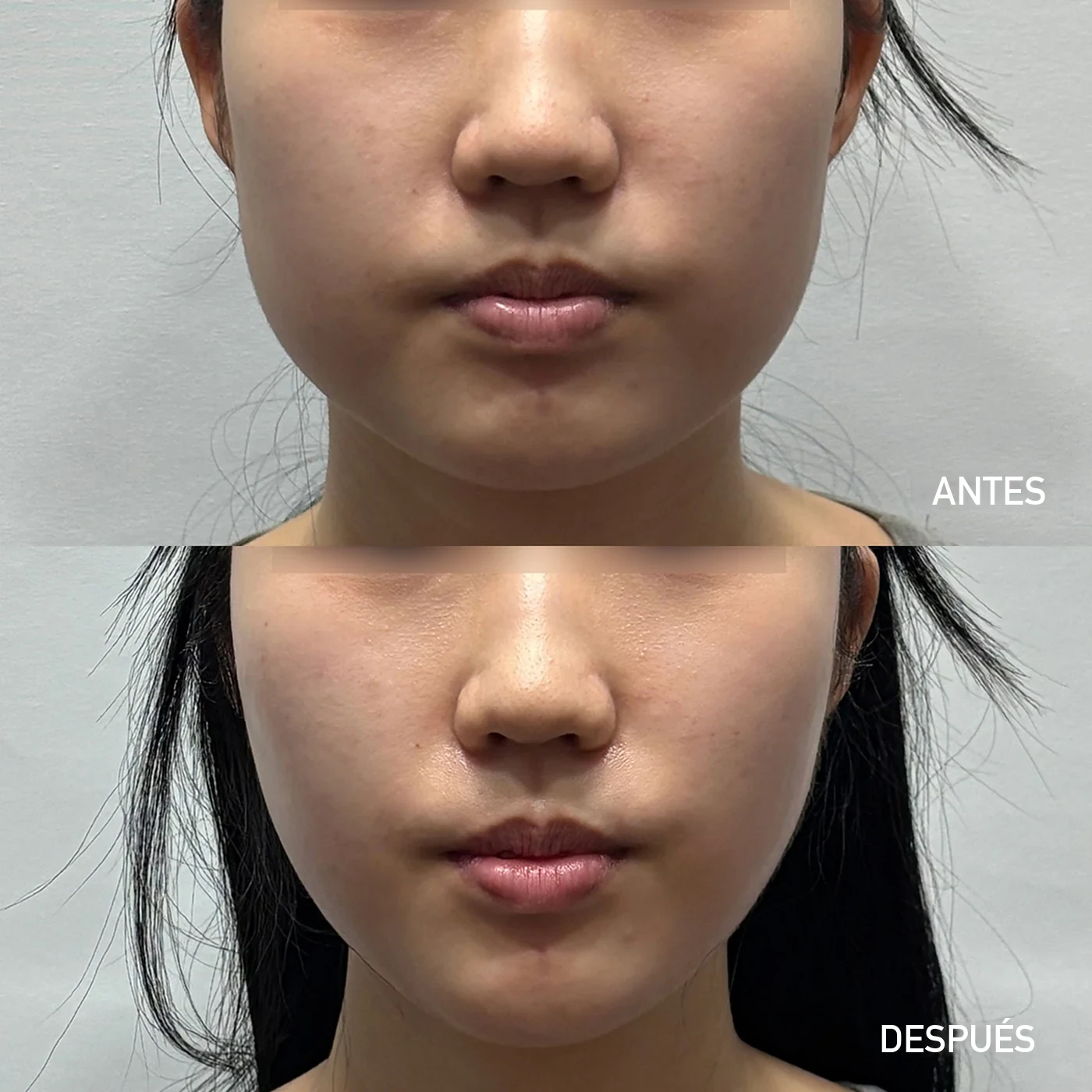 Caso facial de Onda Coolwaves en Dear clínica fotografiado de frente antes y después de un plan de microondas