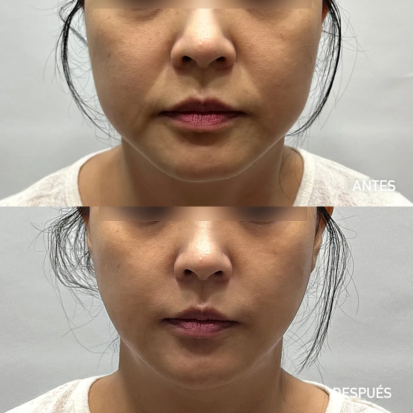 Caso facial de Onda Coolwaves en Dear clínica mostrando el contorno del tercio inferior antes y después de un plan de sesiones de microondas