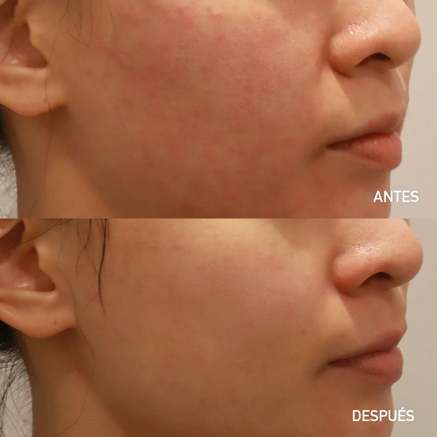Rejuran antes y después en Dear clínica — superficie de la piel más pareja y mejor acondicionada