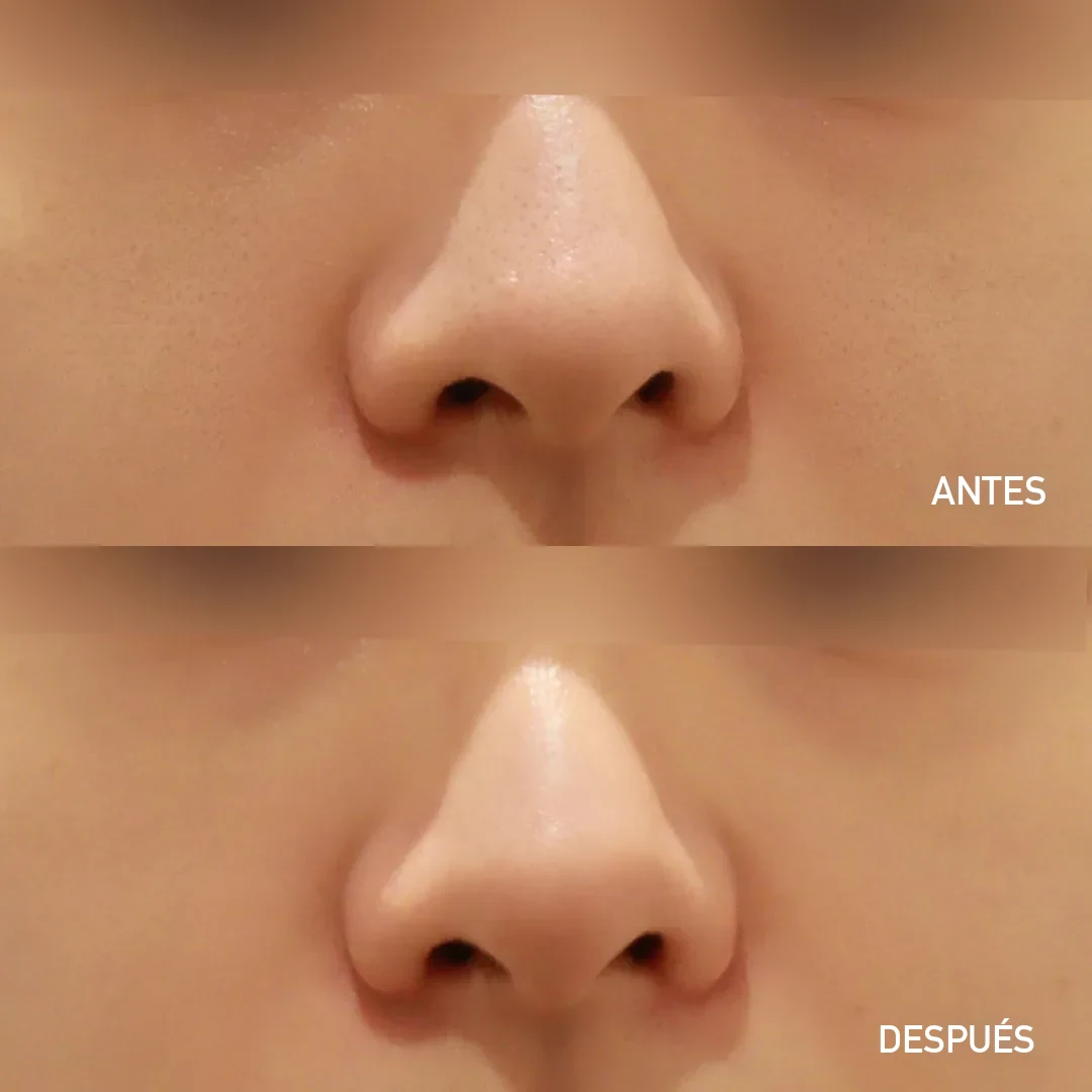Rejuran antes y después en Dear clínica: textura y uniformidad de la piel tras el tratamiento con polinucleótidos