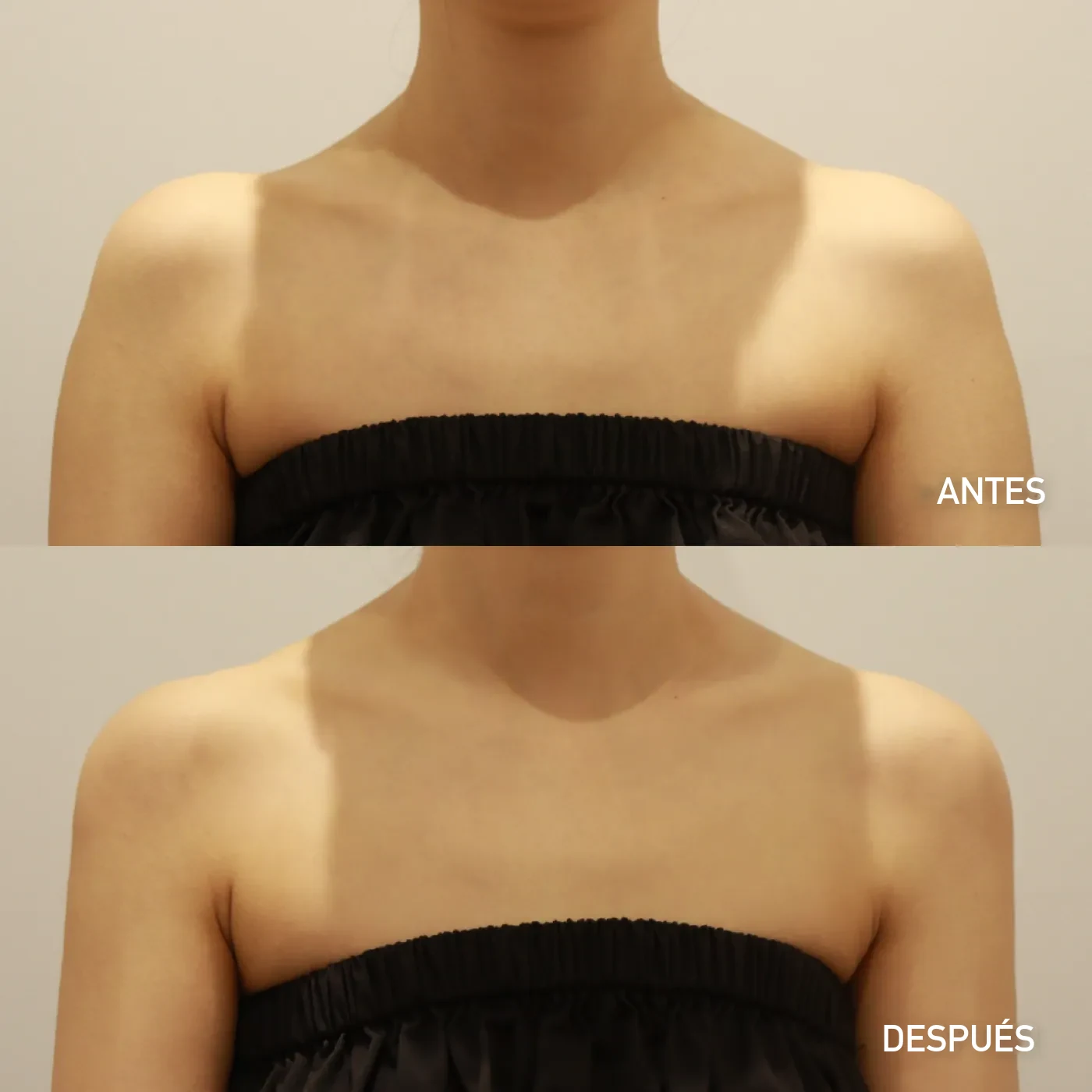Relleno de hombro (shoulder) antes y después — caso de Dear clínica