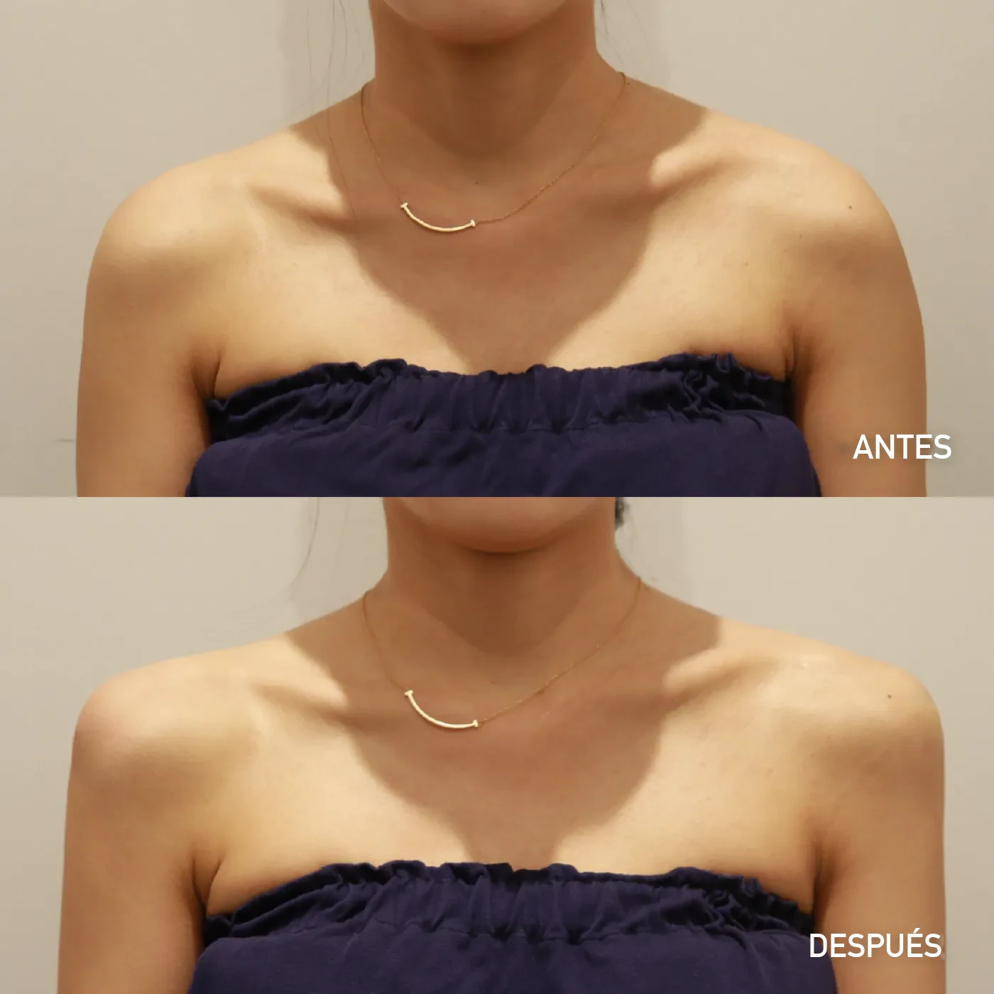 Relleno de la línea del hombro (shoulder) antes y después — Dear clínica