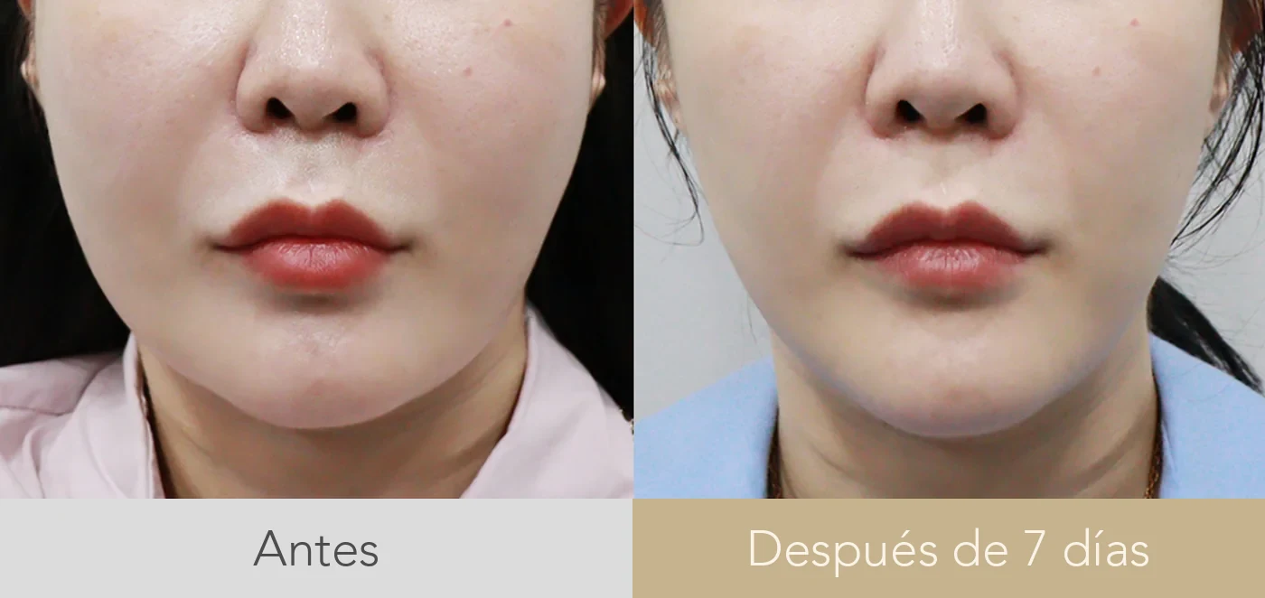 Antes y después de lifting con hilos en Dear clínica, misma paciente, con el contorno mandibular redibujado una semana después de colocar los hilos