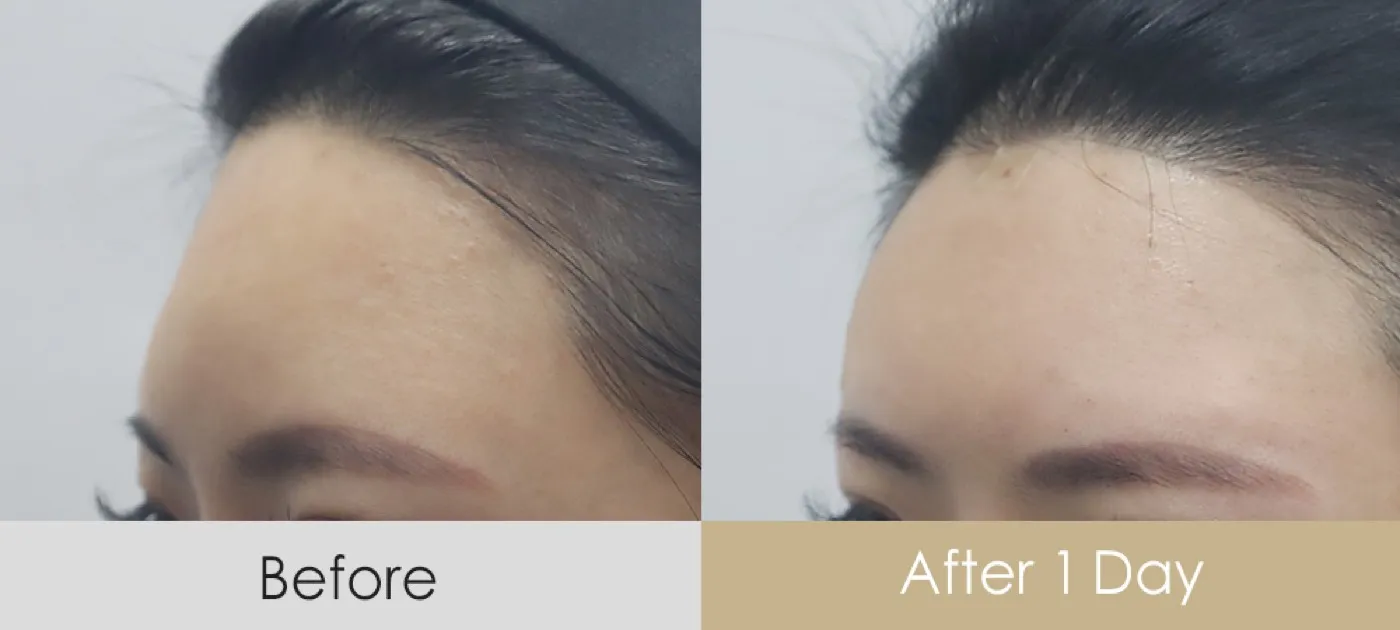 Forehead filler before and after — Dear Clinic