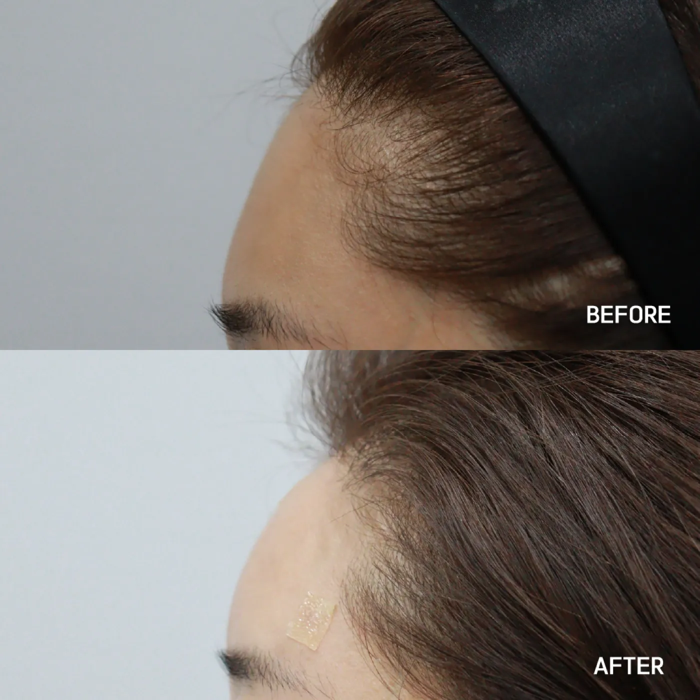 Forehead filler before and after — smoother contour, Dear Clinic case