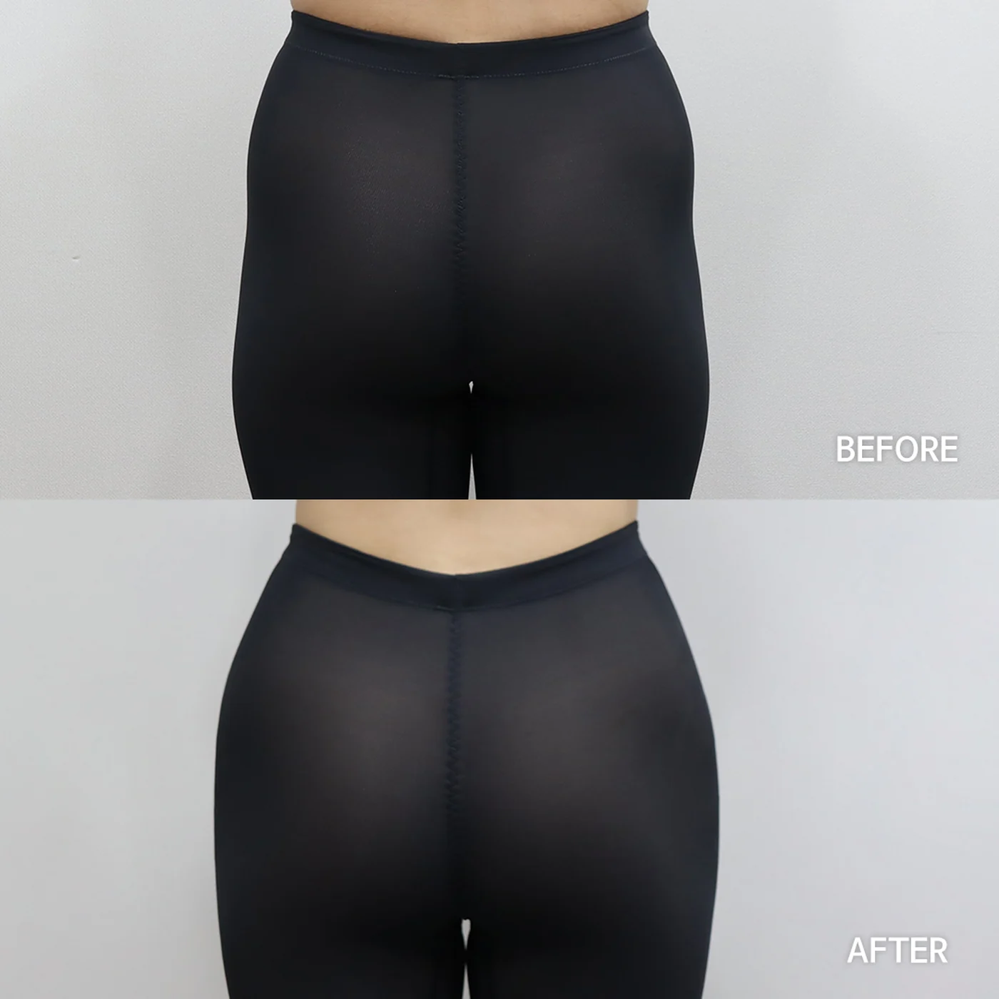 Hip dip filler before and after — same patient, rounder, smoother hip contour, Dear Clinic case