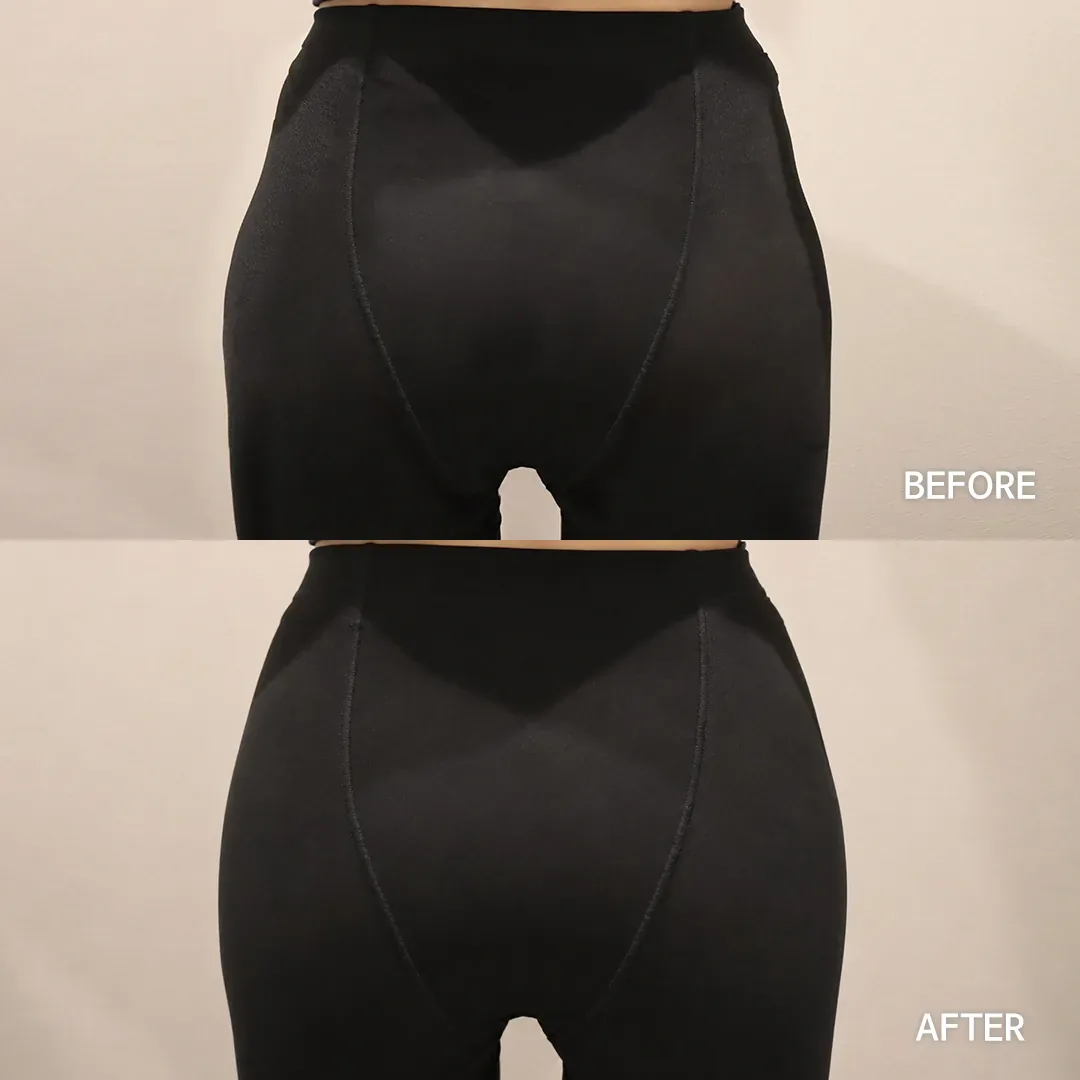 Hip dip filler before and after — same patient, filled hip-dip depression, Dear Clinic case