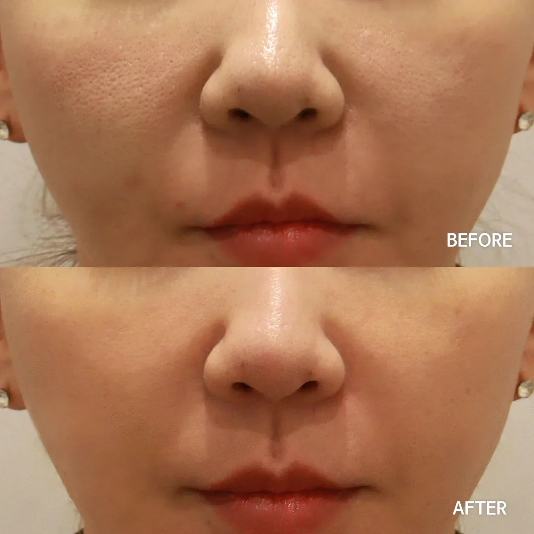 Juvelook collagen stimulator before and after — same patient, firmer, more restored skin, Dear Clinic case